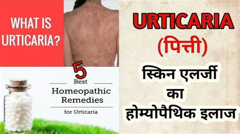 Urticaria Hives Best Homeopathic Medicines For Urticaria Skin