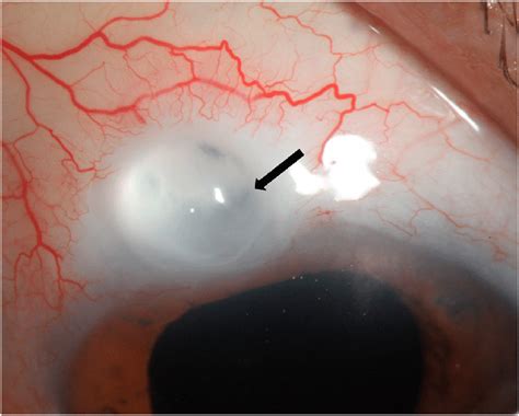 A Slit Lamp Photograph Of The Superior Conjunctival Filtering Bleb