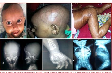 Figure 1 From Hutchinson Gilford Progeria Syndrome Semantic Scholar