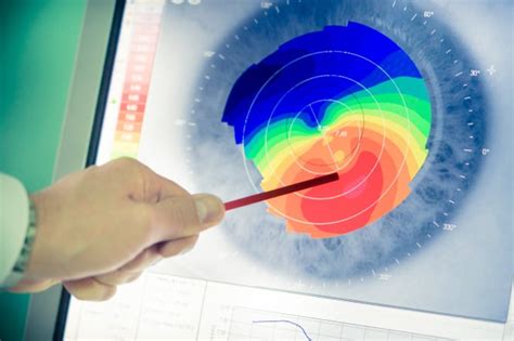 What is Keratoconus & Can Laser Vision Correction Help?