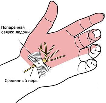 Карпальный туннельный синдром операция. Лечение карпального туннельного ...