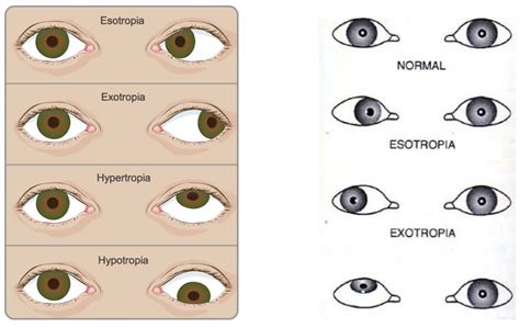 Strabismus (Squint) Singapore | Causes & Treatment Options