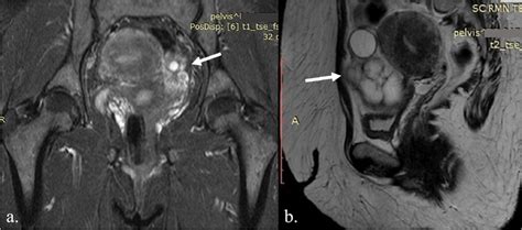 Pelvic MRI Showing Right Adnexal Mass With Median Development Mixed