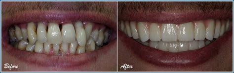 Dental Implants Before And Afters Southland Dental Care