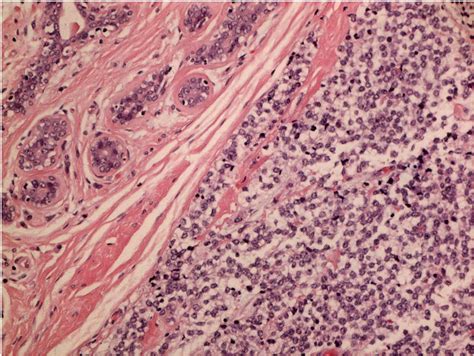 Frontiers Ewings Sarcoma Of The Breast In A Young Woman A Case