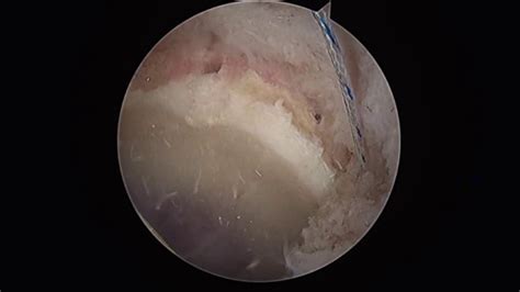 Hip Labral Reconstruction Solutions Youtube