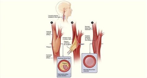 Carotid Artery Disease Dr Peter Vann