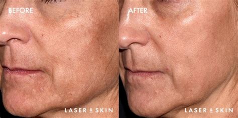 Laser Skin Surgery Treatments Sacramento Northern California