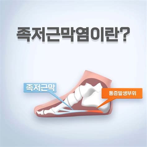 족저근막염 증상 통증 원인 치료 물리치료 가이드