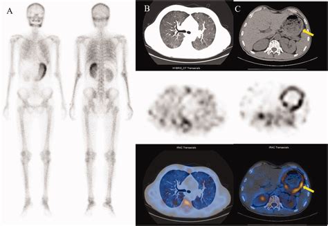 A A Whole Body Scan Using Technetium M Diphosphonate Mtc Mdp