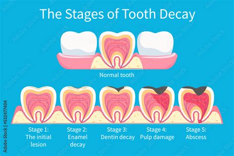 Stages Development Of Tooth Decay Dental Plaque In Enamel And Dentin