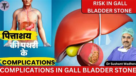 Treatment Of Gall Bladder Stone By Dr Sushant Wadhera Bariatric