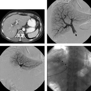 Transhepatic Ipsilateral Right Portal Vein Embolization PVE Extended