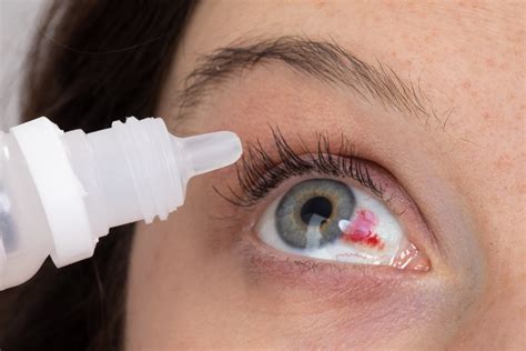 FDA Urges Halt: Risky Eye Drops Pose Infection Threat - Precision Eye - Cataract and Laser Eye ...