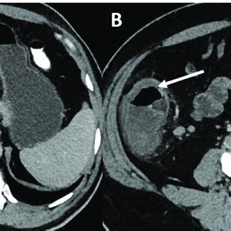 Amebic Liver Abscess In A 42 Year Old Male Axial Images At The Level Download Scientific