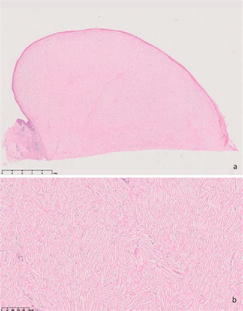 Figure From Two Cases Of Sclerotic Fibroma Of The Skin That Mimicked