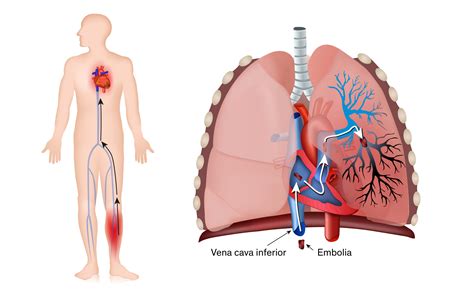 Tromboembolia Pulmonar Centro M Dico Abc