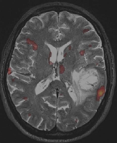 Navigating Astrocytoma: Understanding Survival Rates, Symptoms, and ...