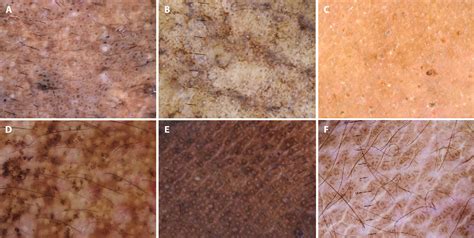 Figure 4 From Dermoscopy Of Inflammatory Dermatoses Inflammoscopy In