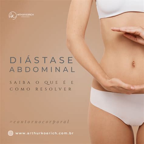 Diástase abdominal saiba o que é e como resolver Dr Arthur Koerich