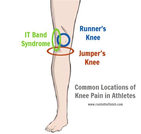 Treatment For Runners Knee Vs Jumpers Knee