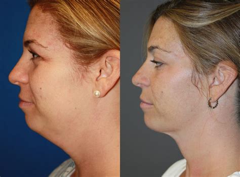 Neck Liposuction Boston Plastic Surgeon Leonard Miller Md