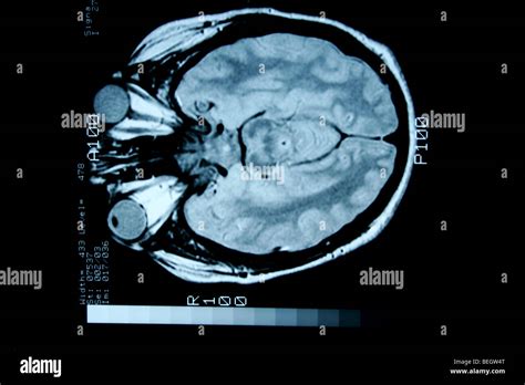 Mri Brain Without Contrast - change comin