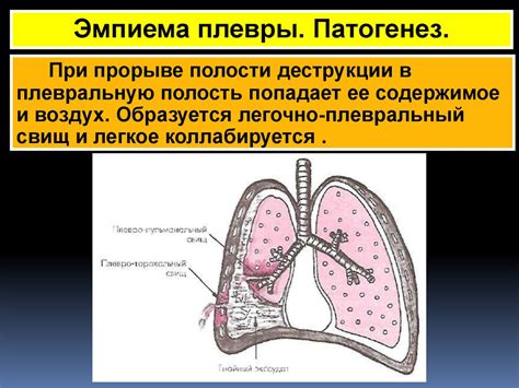 Внелегочный туберкулез. Плеврит - презентация онлайн