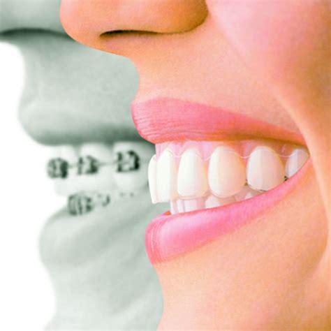 Invisalign Clínica Dentarium