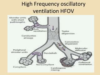 HFOV in Neonates.pptx Guide