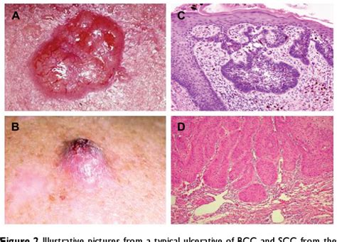 Figure 2 From Clinical Features Related To Xeroderma Pigmentosum In A