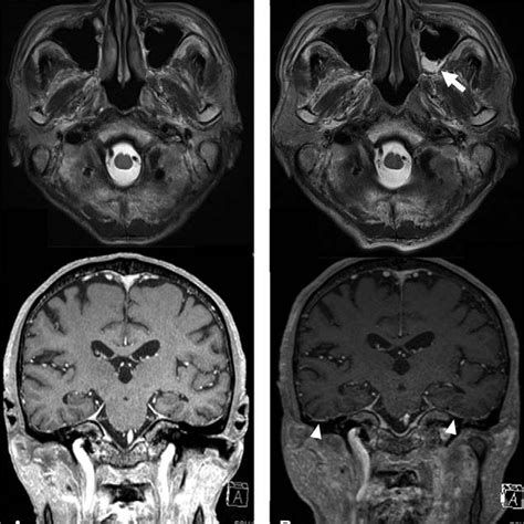 Magnetic Resonance Imaging Of The Head A One Month After The