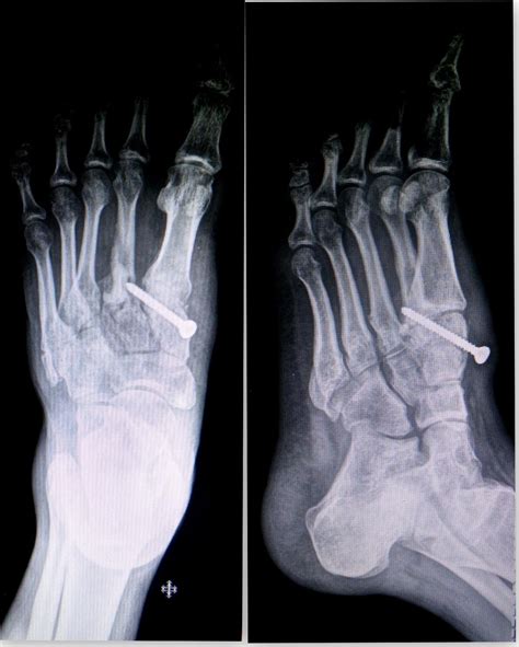 Divergent Lisfranc injury with dislocation of great toe interphalangeal ...