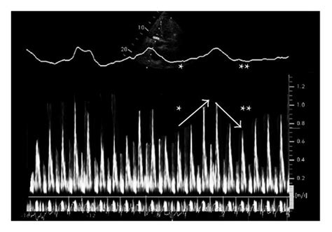 Echocardiographic Features Of Constrictive Pericarditis A Pulse Wave Download Scientific