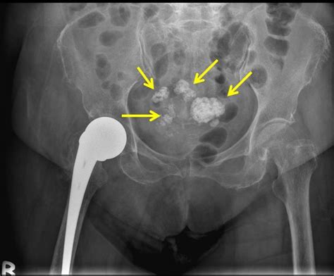 Calcified uterine fibroid – Radiology Cases