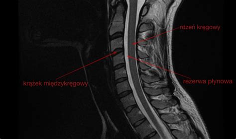 Uszkodzenie Rdzenia Kręgowego Przyczyny Objawy Leczenie Mobile Legends