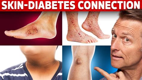 9 Diabetic Skin Problems That Indicate Diabetes Youtube