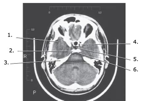 Rtt Head Diagram Quizlet