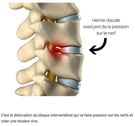 La Hernie Discale L5S1 Lombafit