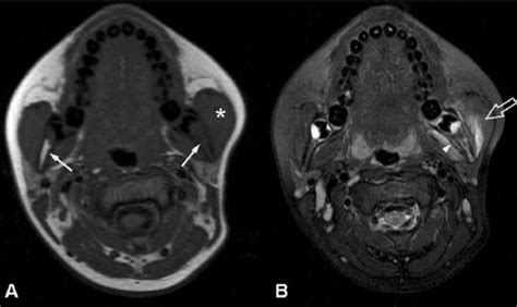 Axial T1 A And Axial T2 Fs B Mri Images Showing Osteomyelitis Of Download Scientific