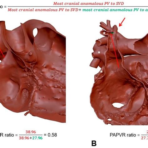 Determination of the PAPVR ratio. (A) The calculated formula suggests a... | Download Scientific ...