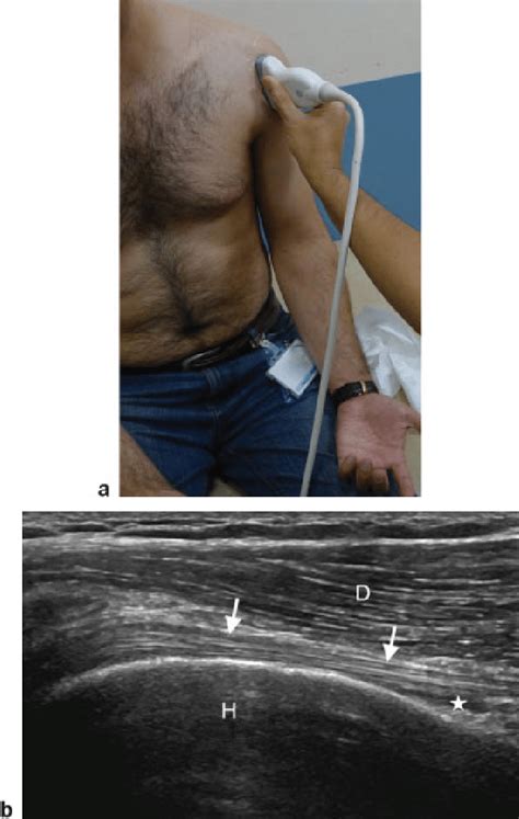 Long head of biceps (LHB) tendon (long axis). (a) Transducer placement ...