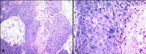 A Rare Case Of Anal Squamous Cell Carcinoma Metastasizing To The