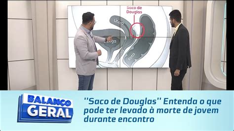 Saco De Douglas Entenda O Que Pode Ter Levado Morte De Jovem