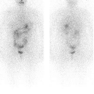 Anterior And Posterior Pre I Therapy Planar Whole Body Scan