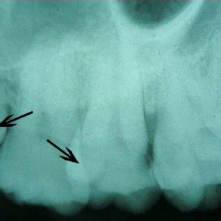 Pre Operative Left Side Intra Oral Peri Apical Radiograph Showing