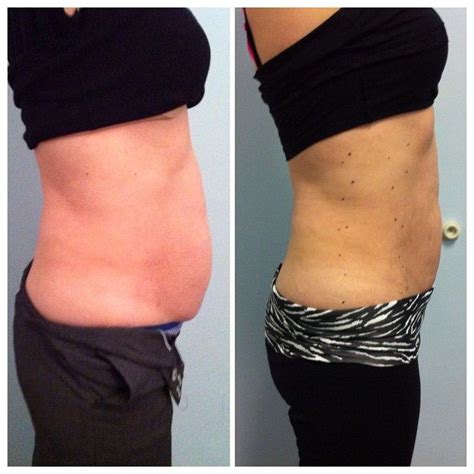 Lila Body Contouring Laser Of A Female Abdomen Before After