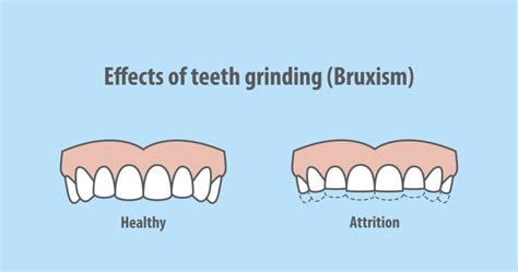 How Bruxism Affects Dental Implants Greater Louisville Oral And Maxillofacial Surgery Associates