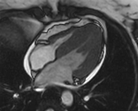 Myocarditis Mri Wikidoc