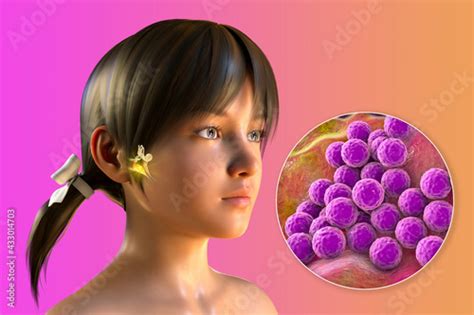 Staphylococcus Aureus Bacterium As A Cause Of Otitis Media Stock